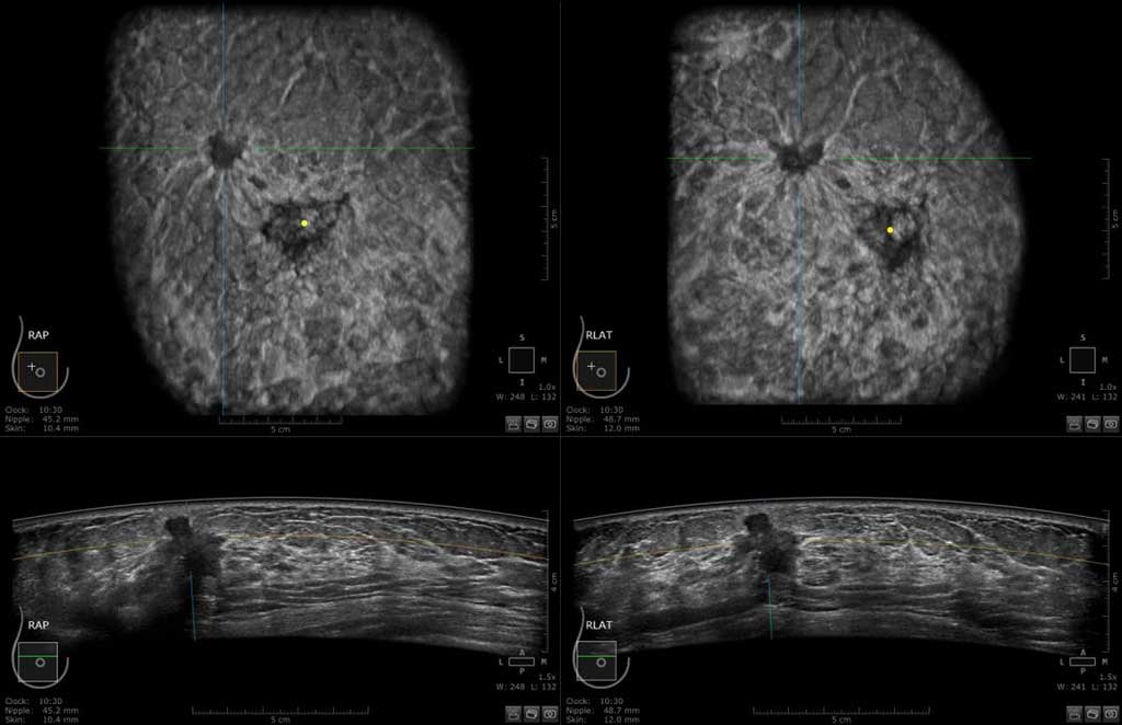 Hình ảnh khối u trên siêu âm