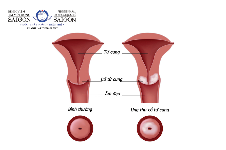 Tử cung bình thường và ung thư cổ tử cung
