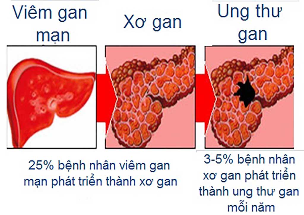 viêm gan mạn - Bệnh viên Tai Mũi Họng Sài Gòn