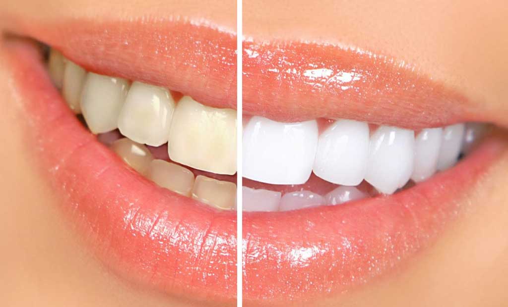  Tẩy trắng răng giúp khắc phục hàm răng bị ố màu. 