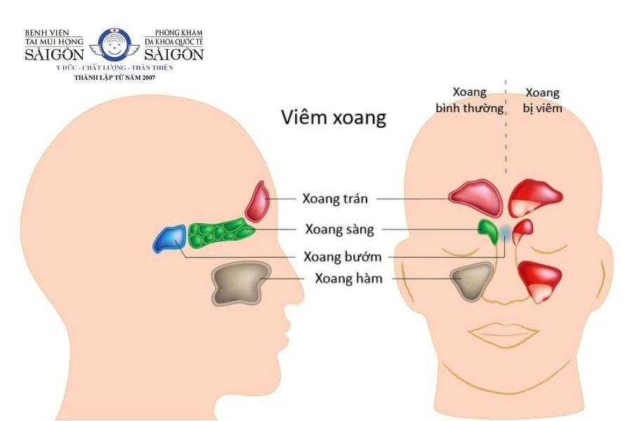 Cần điều trị viêm xoang khi có dịch trong xoang mũi