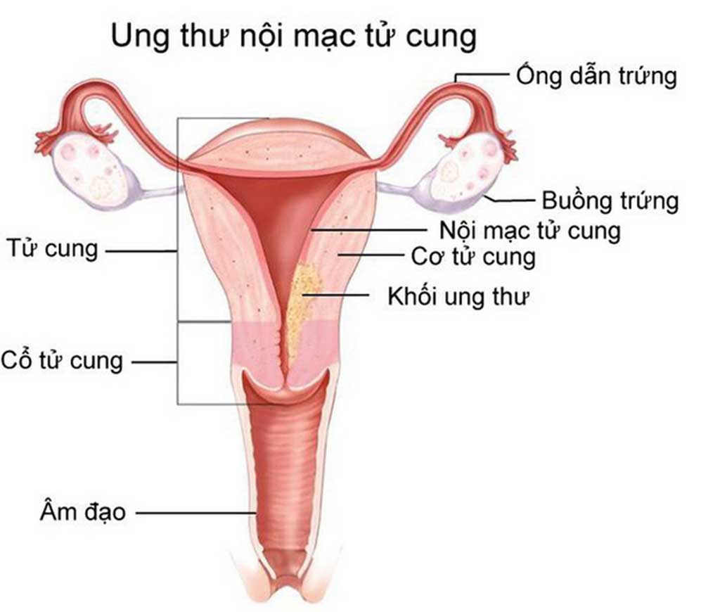 Ung thư nội mạc tử cung - Phòng Khám Đa Khoa Quốc Tế Sài Gòn