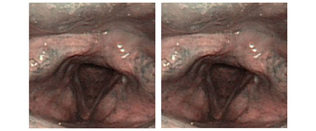 Dưới nội soi NBI: Không thấy hiện tượng viêm trợt niêm mạc hạ họng. Dịch bám vào dây thanh hai bên.