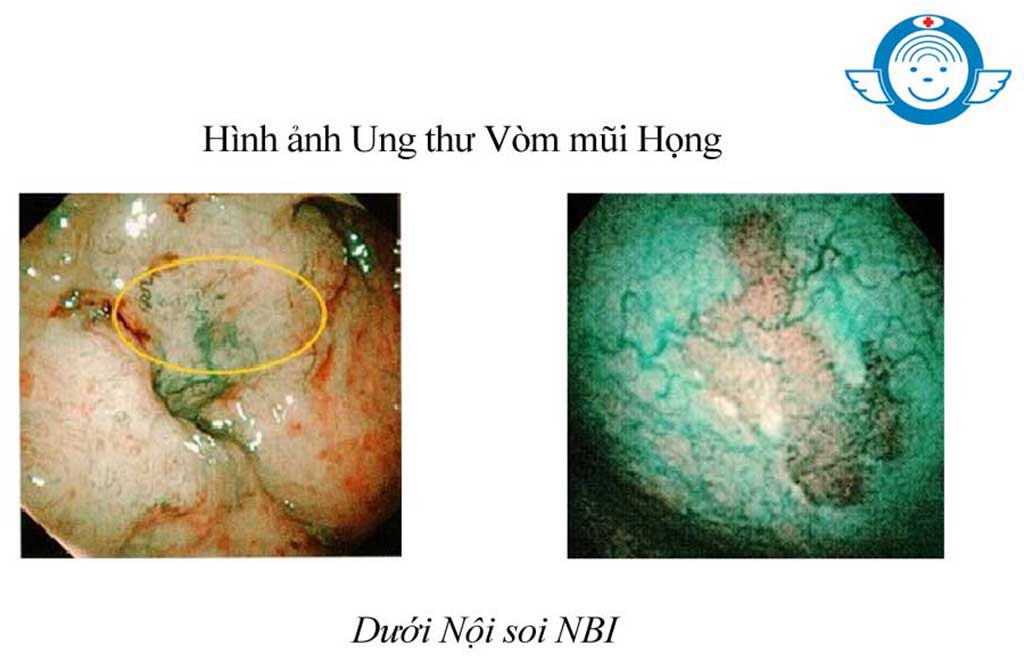 Hình ảnh được chụp bằng nội soi NBI tại Bệnh Viện Tai Mũi Họng Sài Gòn