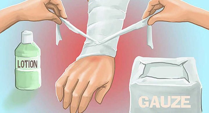 Lưu ý khi xử trí bỏng nước sôi