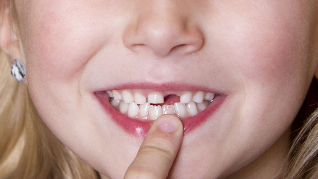 4 bệnh răng miệng thường gặp ở trẻ - Phòng Khám Đa Khoa Quốc Tế Sài Gòn