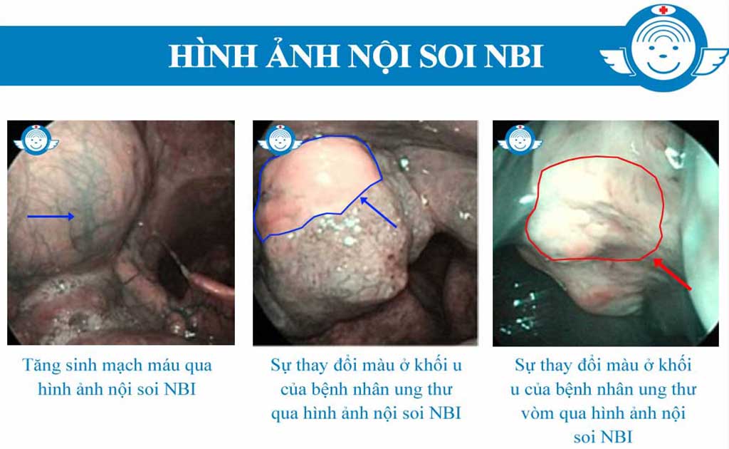 Hình ảnh được chụp bằng nội soi NBI tại Bệnh Viện Tai Mũi Họng Sài Gòn