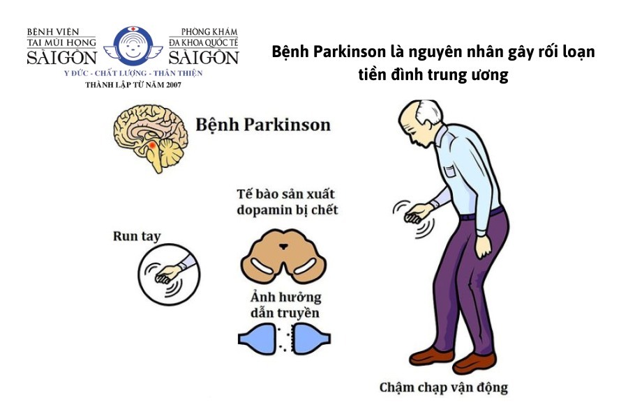 Rối loạn tiền đình trung ương do bệnh Parkinson