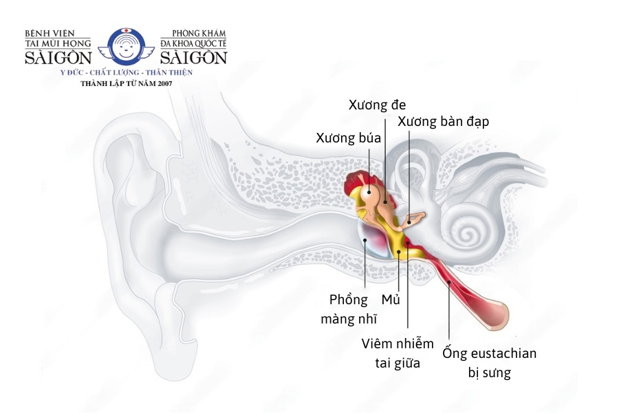 Hình minh họa cơ chế viêm tai giữa