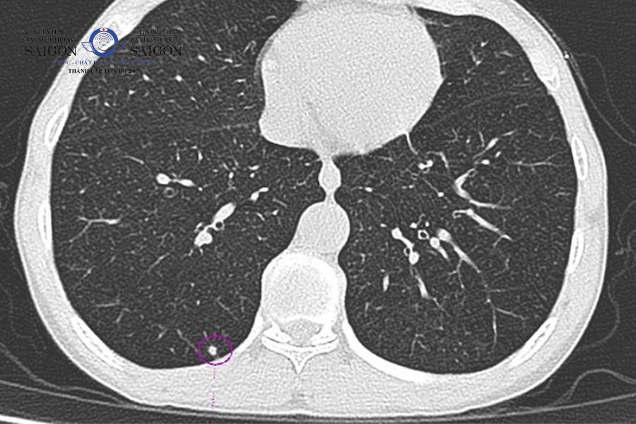 Phương pháp CT Scan phổi liều thấp