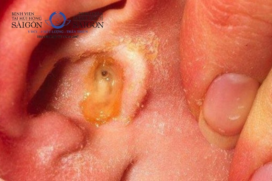 Triệu chứng viêm ống tai ngoài