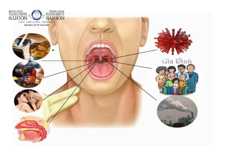  Xác định ung thư vòm họng bằng siêu âm cổ họng
