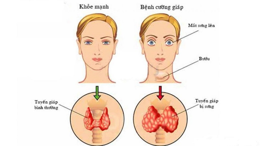 Bệnh cường giáp gây ung thư