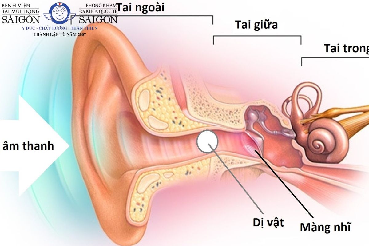 Trẻ đưa dị vật vào trong tai