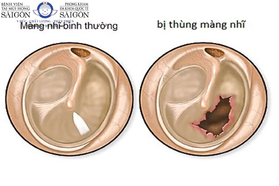 Thủng màng nhĩ có bị điếc không