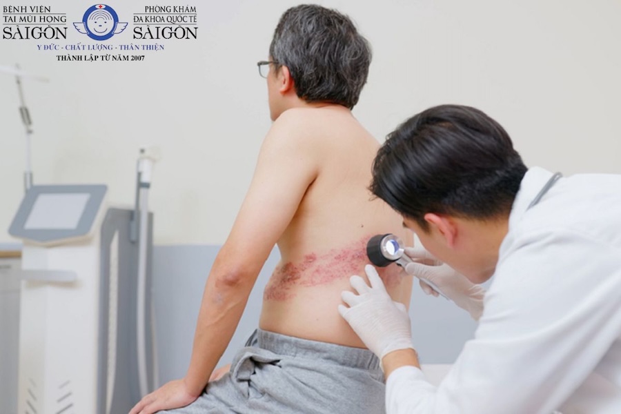 Điều trị zona thần kinh