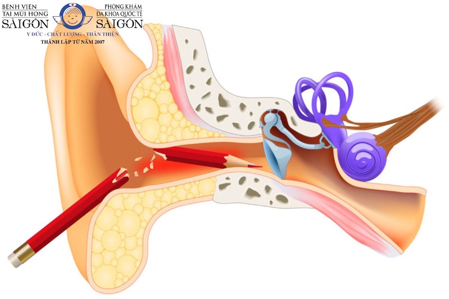 Cách nhận biết thủng màng nhĩ