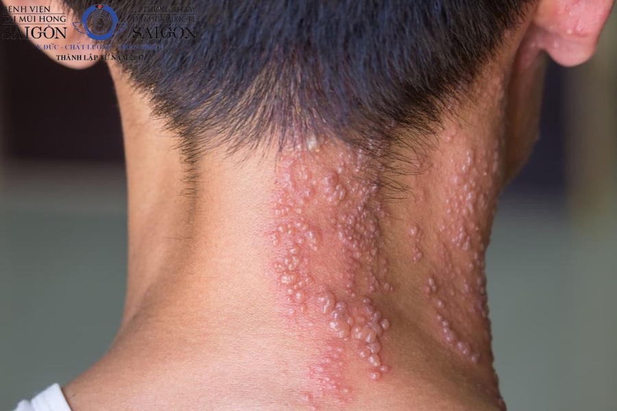Biểu hiện của zona thần kinh