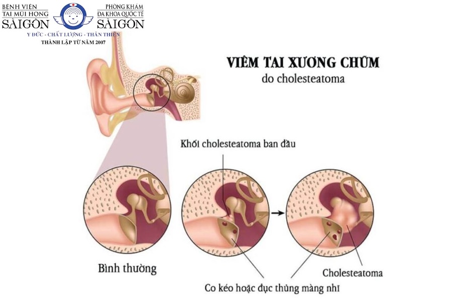 Thủng màng nhĩ có nghe được không