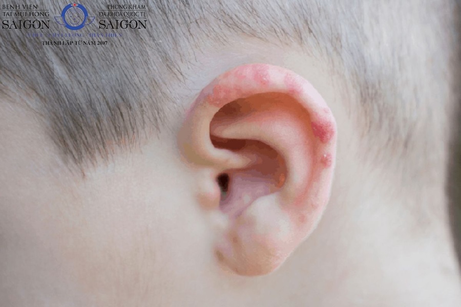 Hình ảnh bệnh zona thần kinh