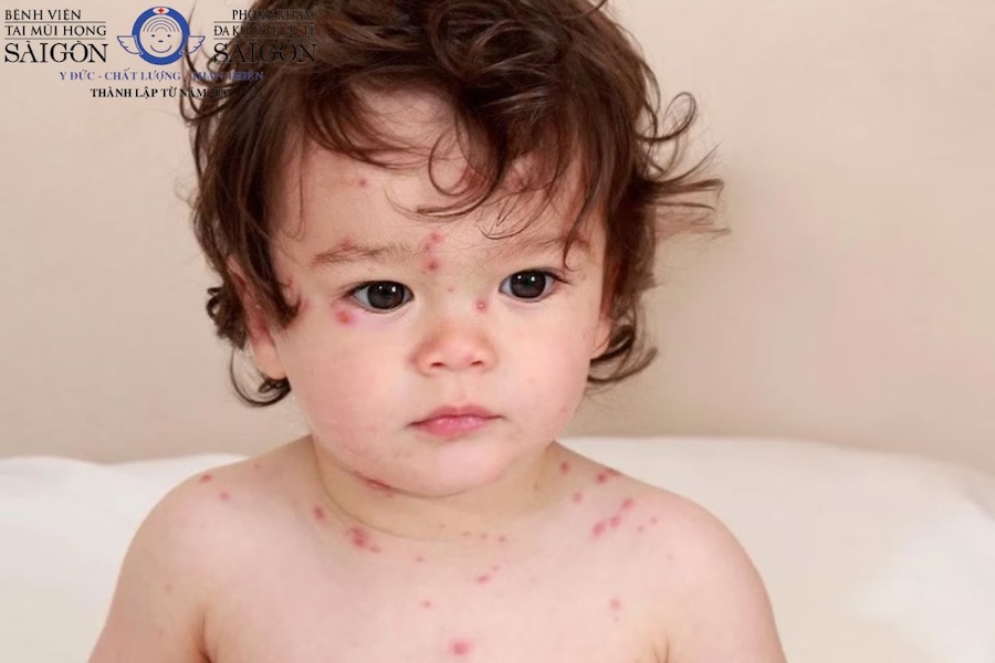 Hình ảnh zona thần kinh 