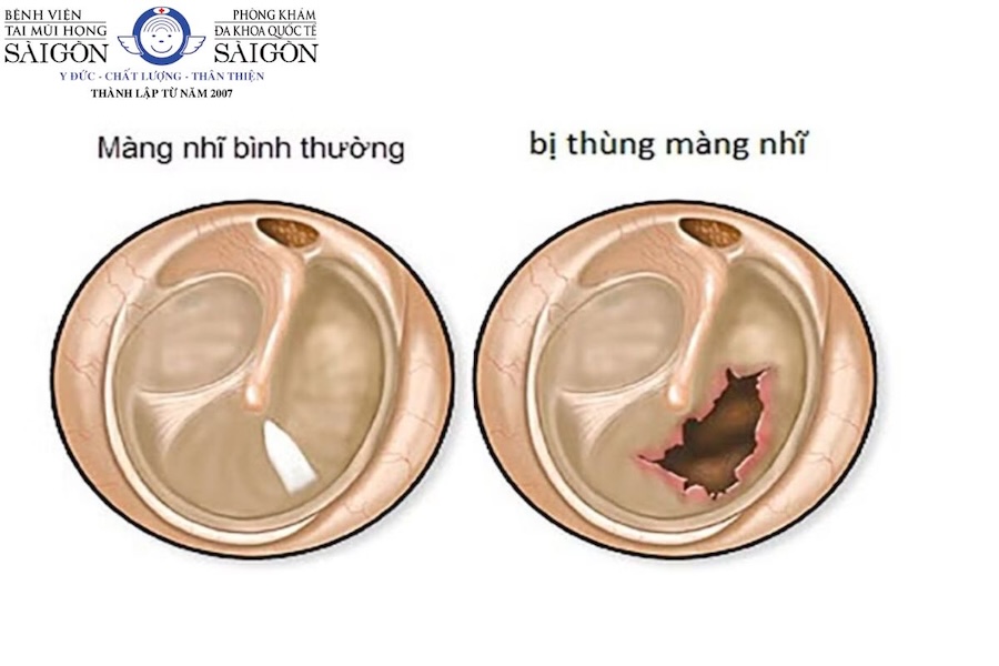 Thủng màng nhĩ có bị điếc không