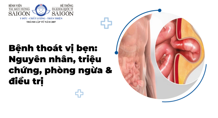 Thoát vị bẹn