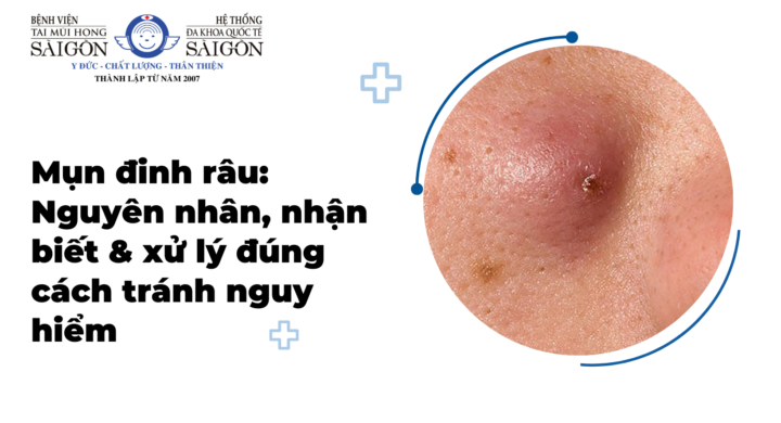 Mụn đinh râu