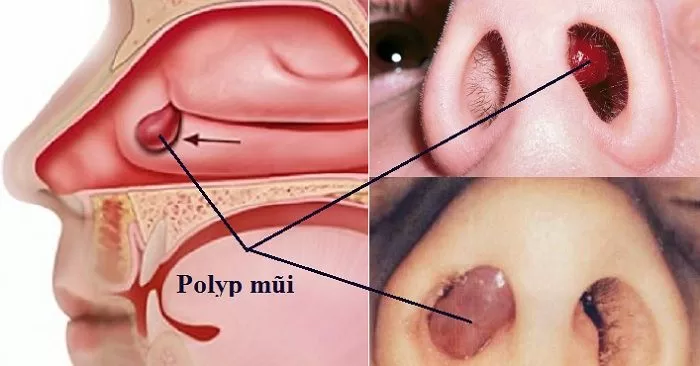 tai sao bi nghet mui keo dai 2 jpg